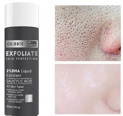 Salicylic Acid Blackhead Treatment