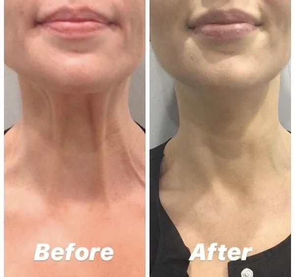 neck cream before and after